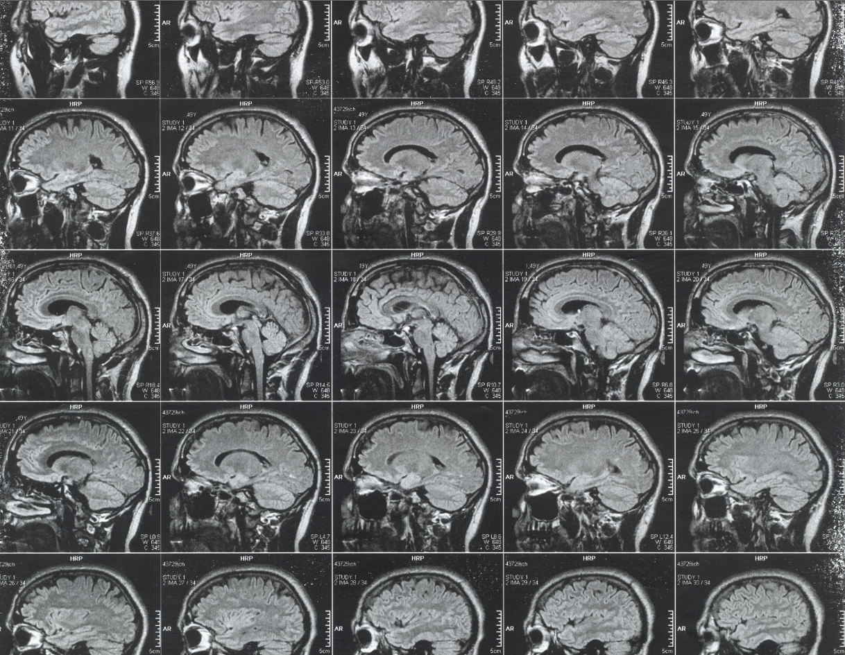 CT scan of a brain