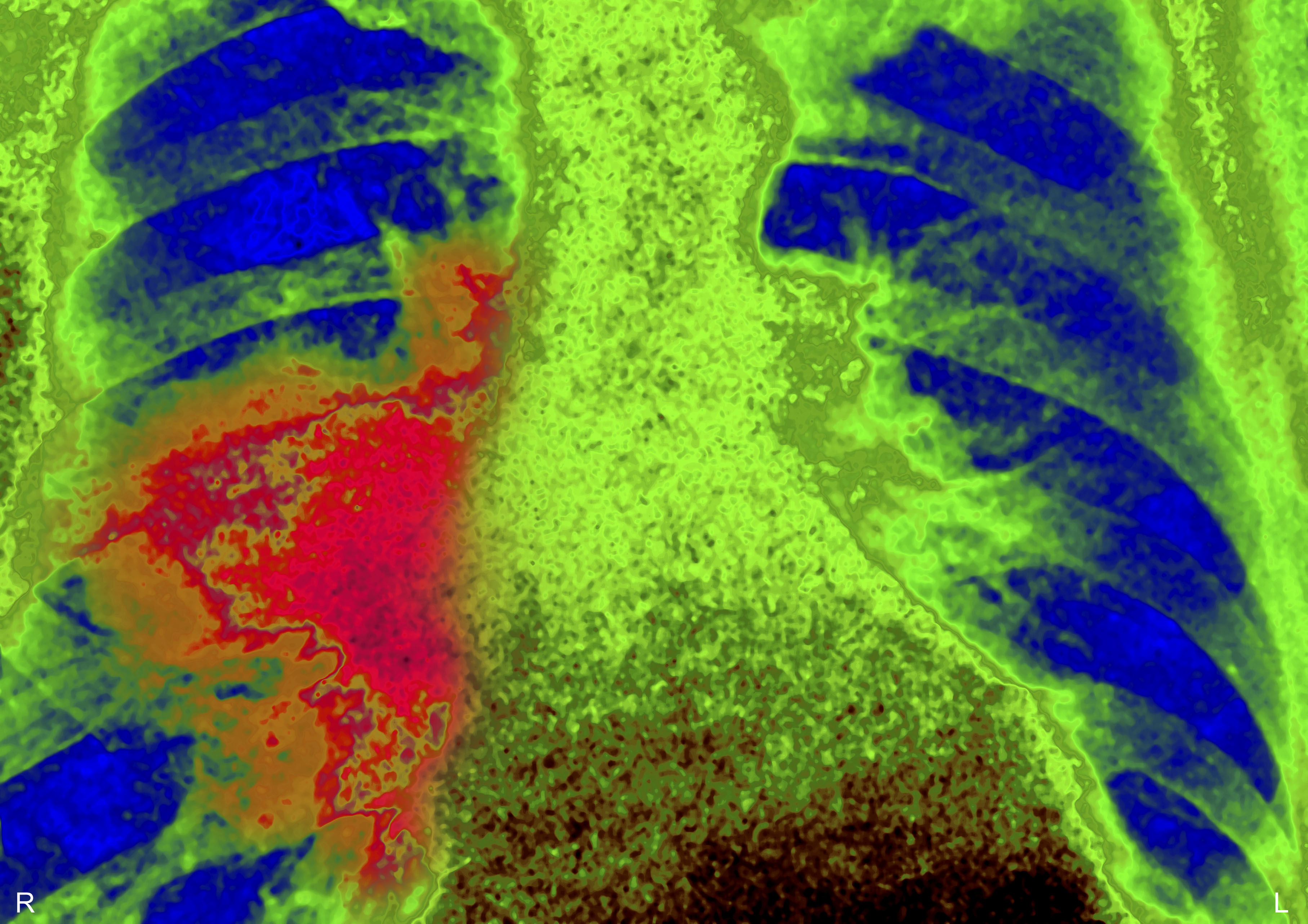 Lung Cancer, X-Ray