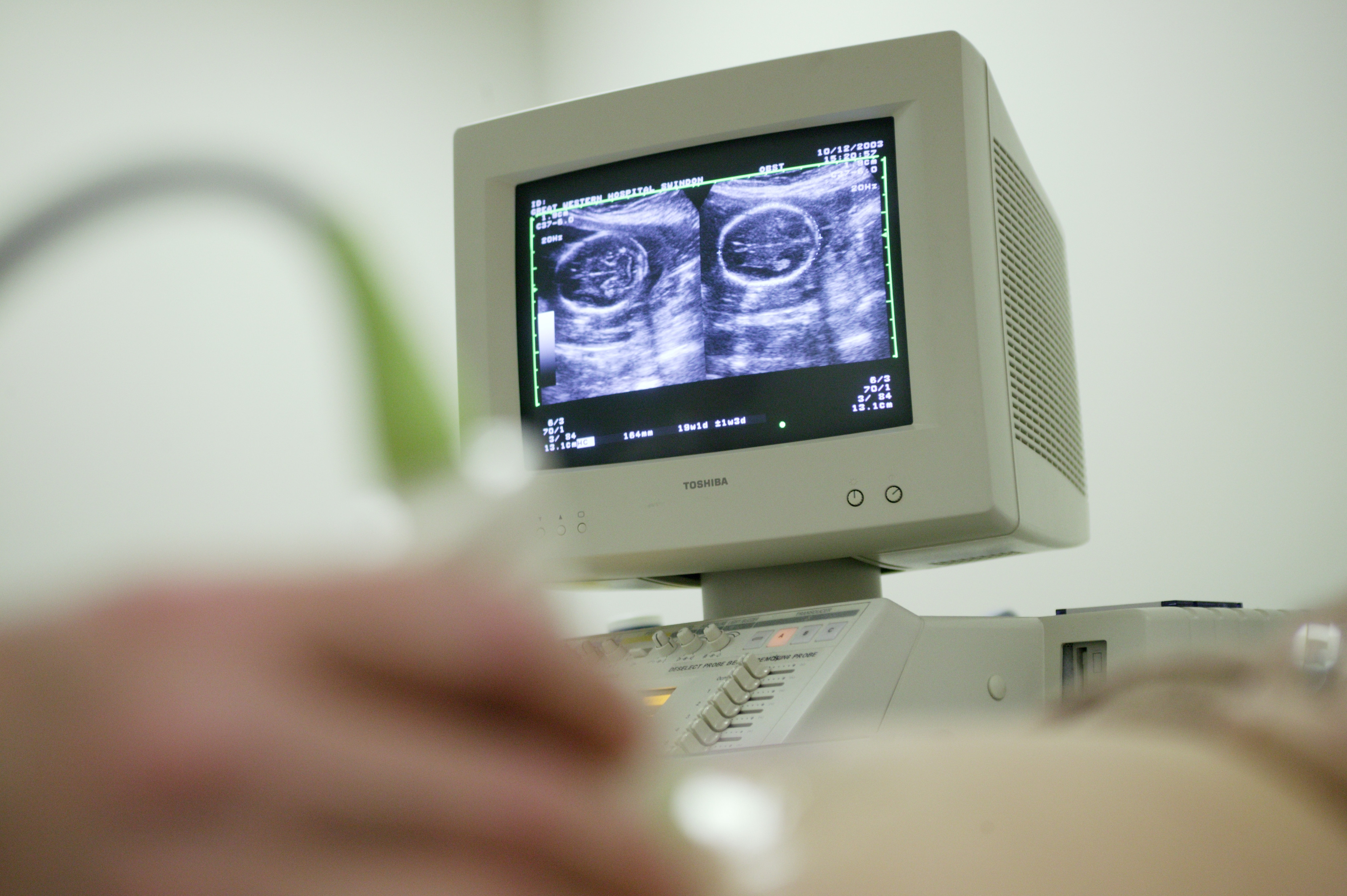 Pregnancy ultrasound
