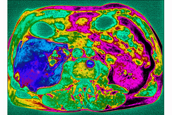 Liver cancer, scan