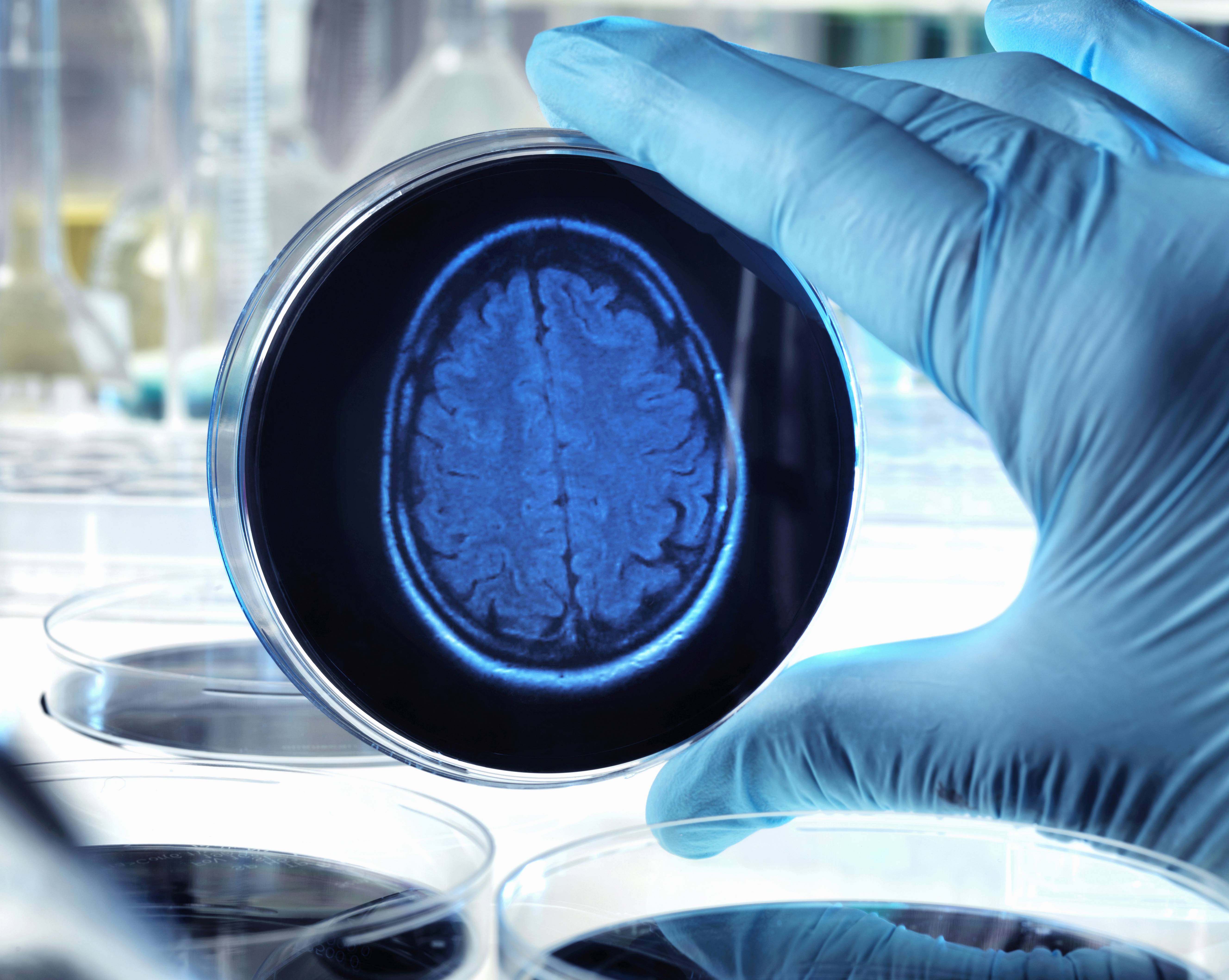 Alzheimer's Biogen Eisai