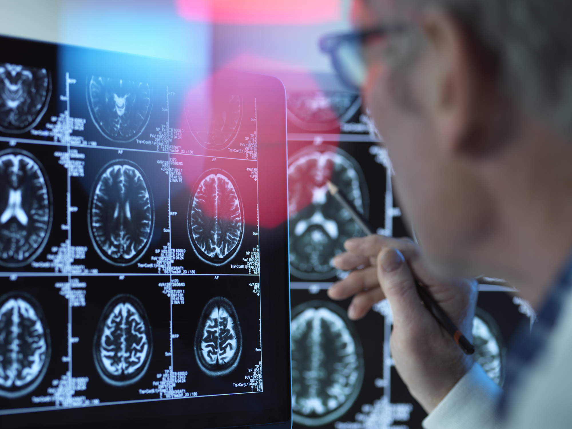 Biogen Alzheimers Drug Data