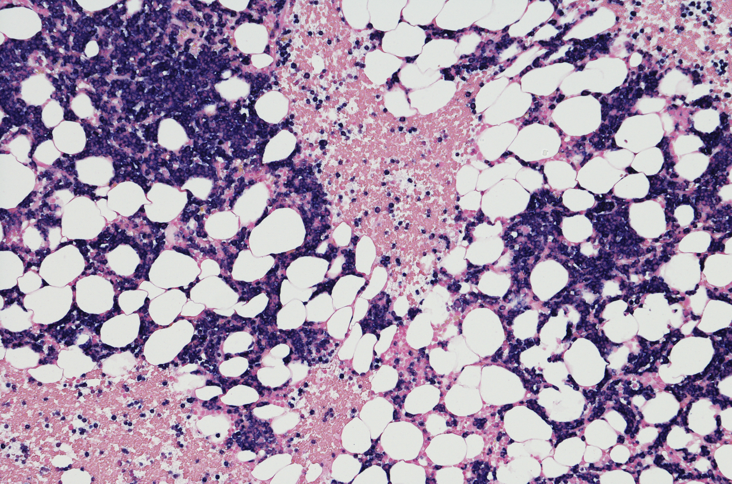 Multiple myeloma MMRF