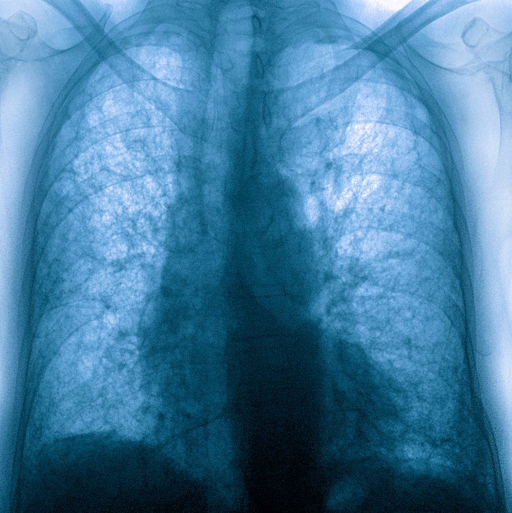 A lung X-ray showing pulmonary fibrosis