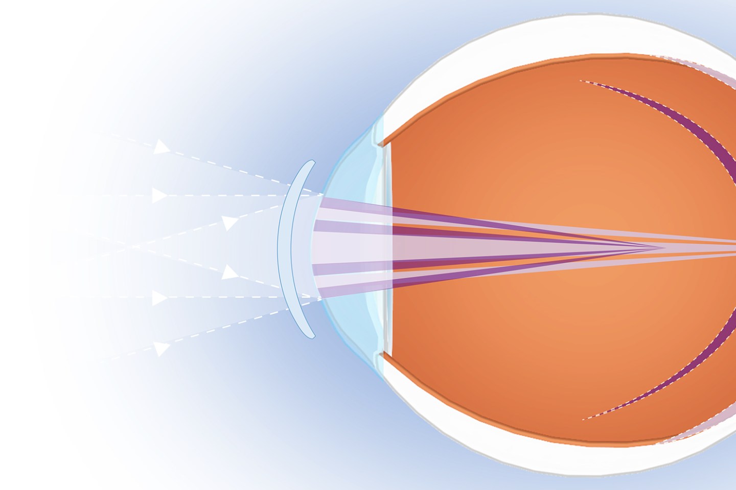 A new contact lens that slows nearsightedness is a boon for optometrists