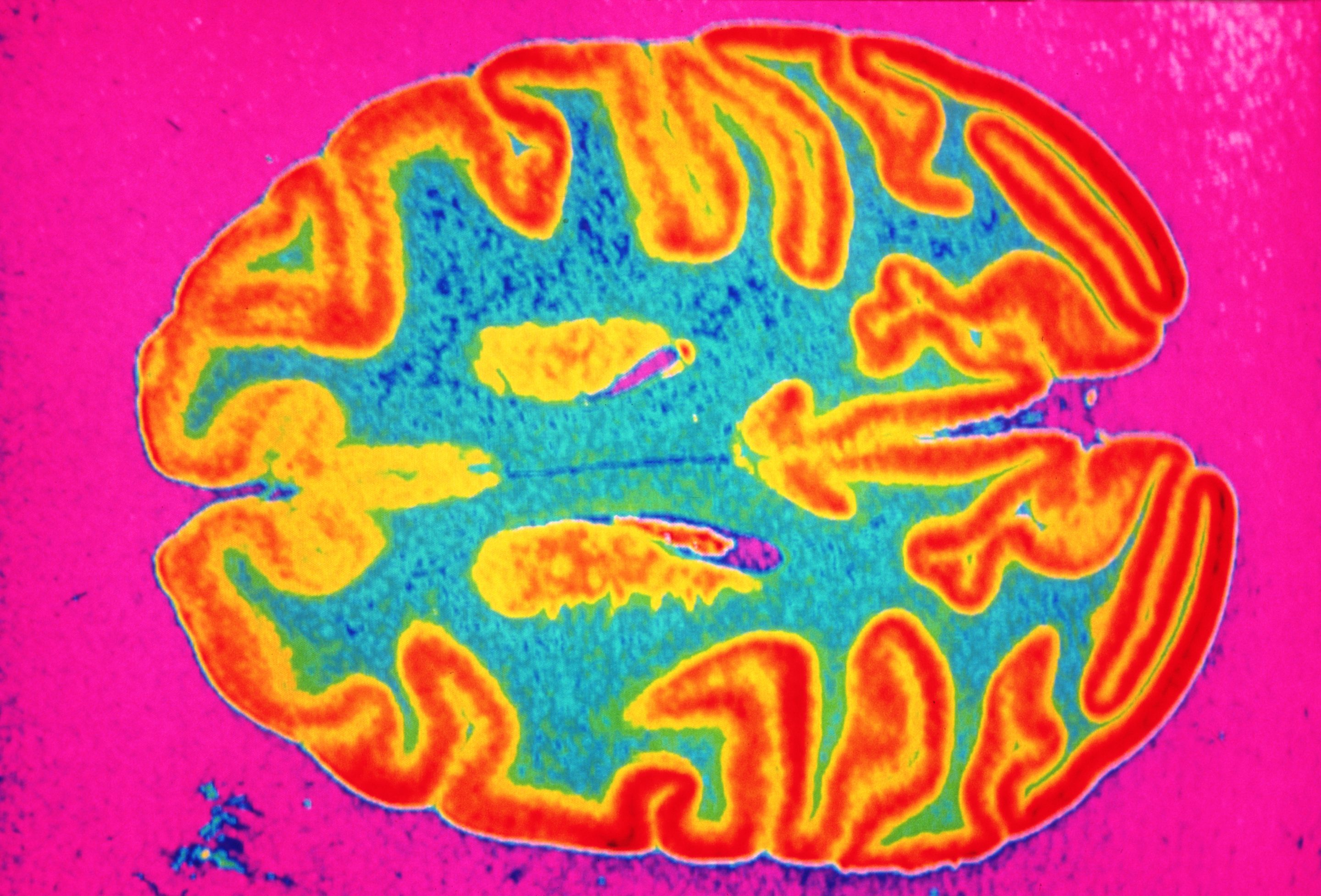 A cross section of a brain.