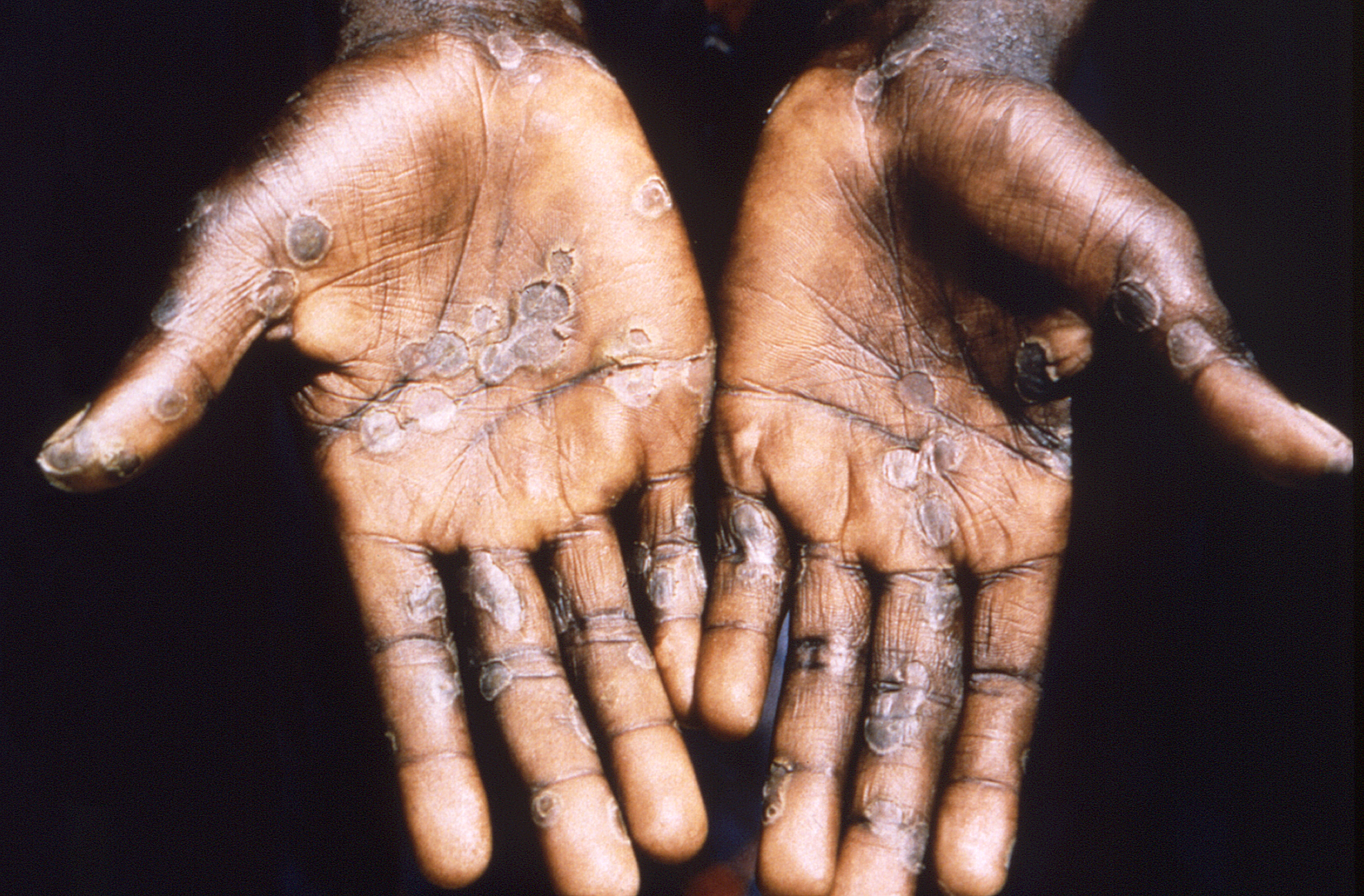 Close-up of a patient's hands showing lesions from the monkeypox virus in the Democratic Republic of the Congo, 1997.