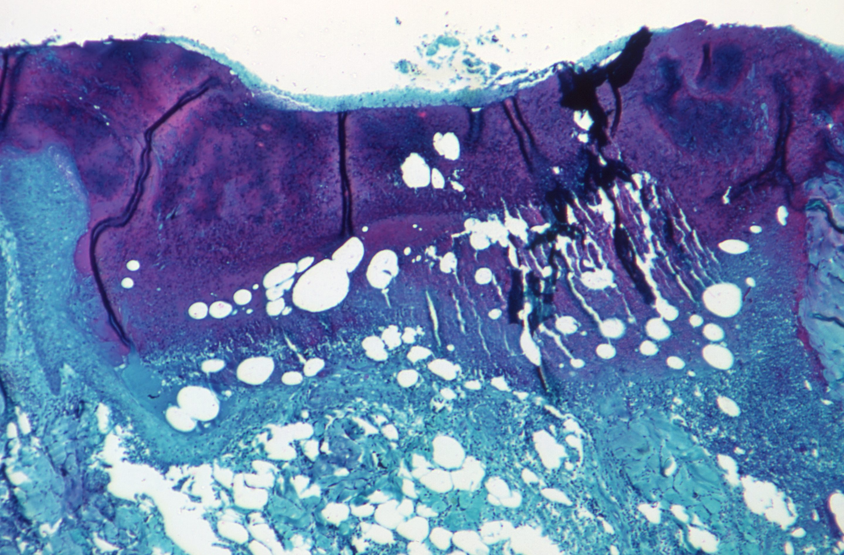 Under a microscope magnification of 50X, this image depicted a section of skin tissue, harvested from a lesion on the skin of a monkey, that had been infected with monkeypox virus, 1968. Courtesy CDC.