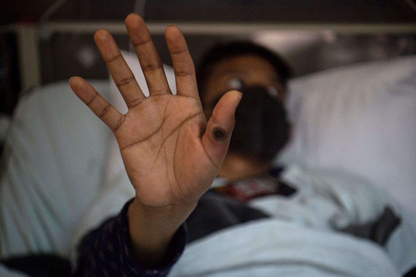 White men initially suffered the highest number of monkeypox cases in the U.S. Not anymore
